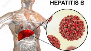 Hepatitis B
